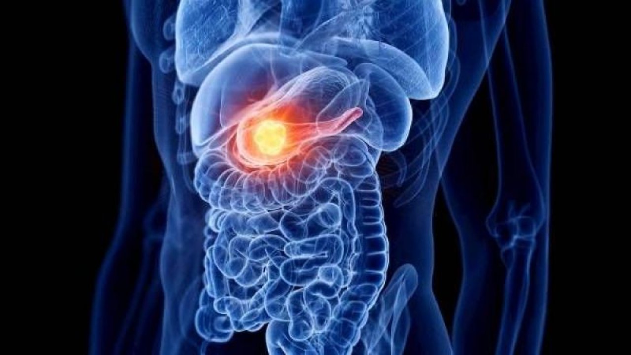 Obezite ile Pankreas Kanseri Arasında Bağlantı Var