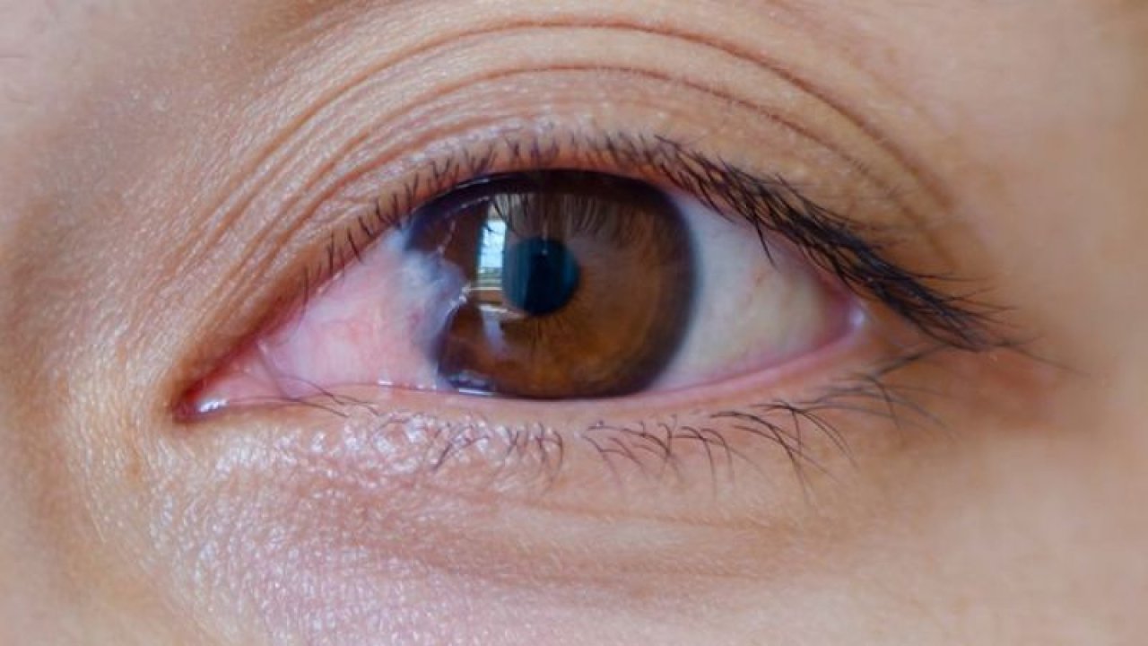 Göz Hastalıkları Uzmanı, Pterjium Hastalığı ve Kalıcı Görme Bozuklukları Hakkında Uyarıyor